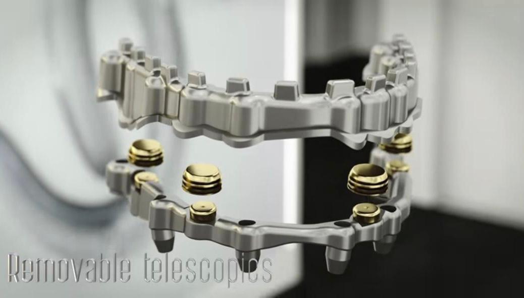 Removable telescopics